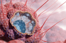 Idiopathische Lungenfibrose