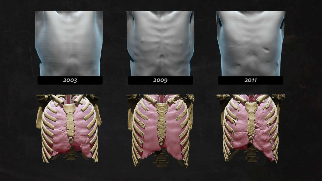 3D-Illustration: Brustkorb, Rippen und Lungen im zeitlichen Vergleich, basierend auf CT-Scan