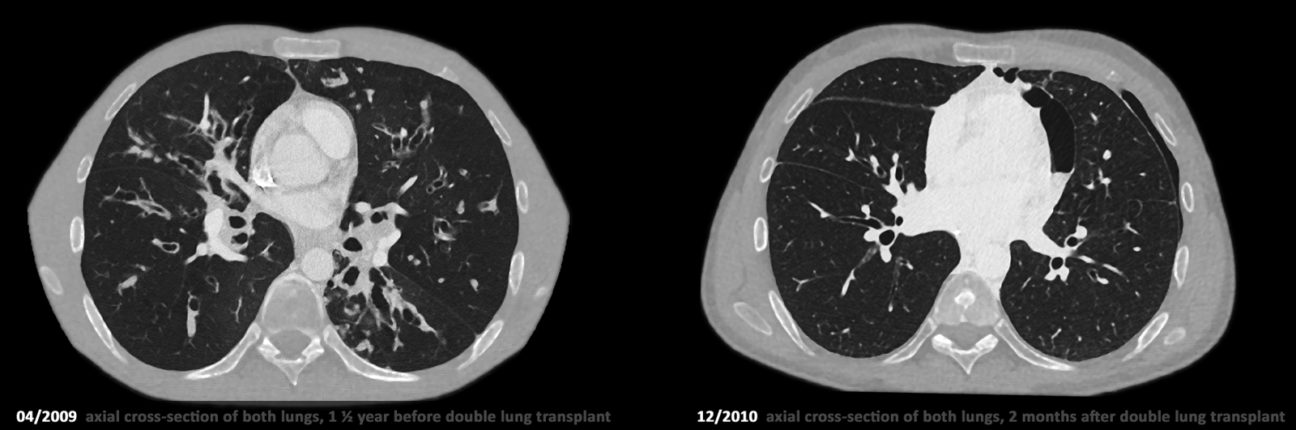Foto: axialer Thorax-CT-Scan eines Mukoviszidose-Patienten vor und nach erfolgreicher Lungentransplantation