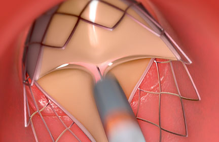Aortenklappenersatz via Herzkatheter