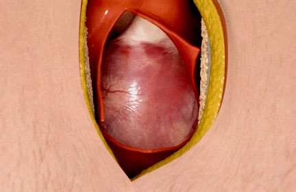 Sternotomie